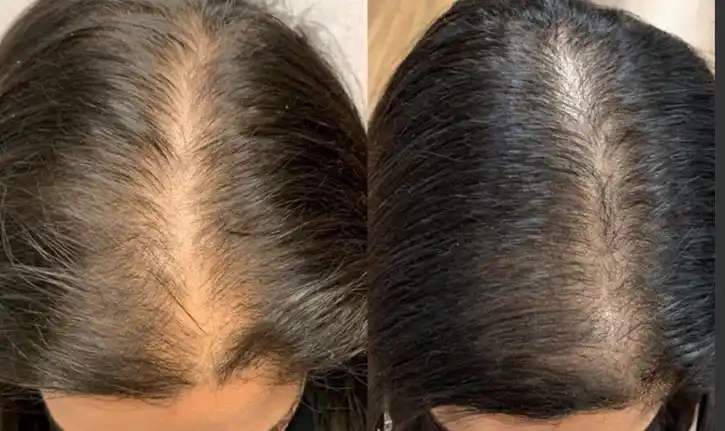 before and after treatment with keralase