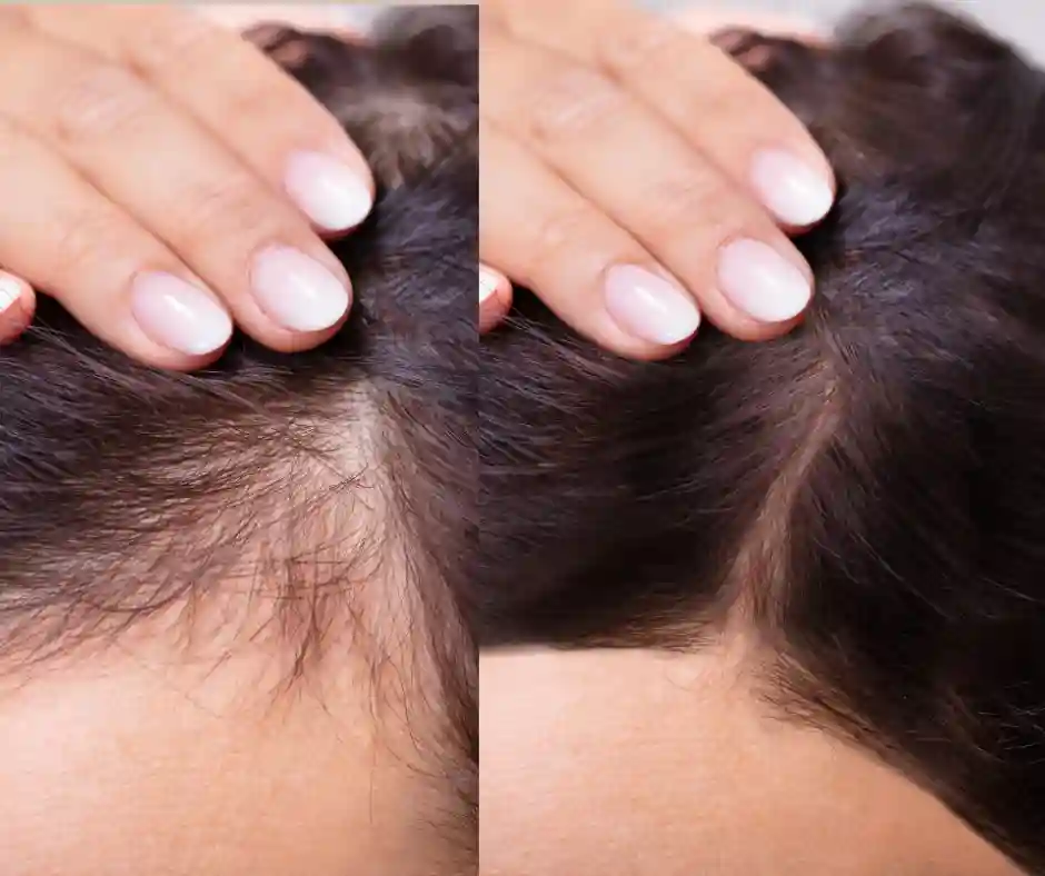 hair restoration before and after