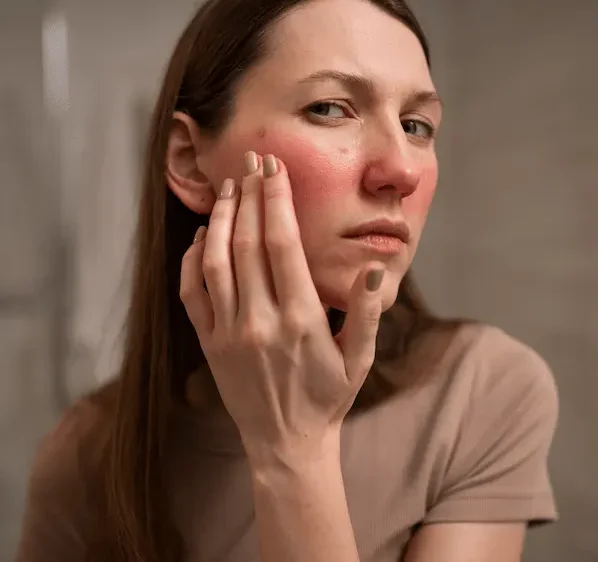 woman dealing with rosacea on her face