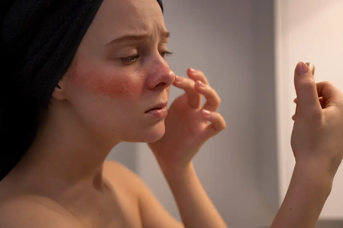 woman looking at her rosacea redness on her face