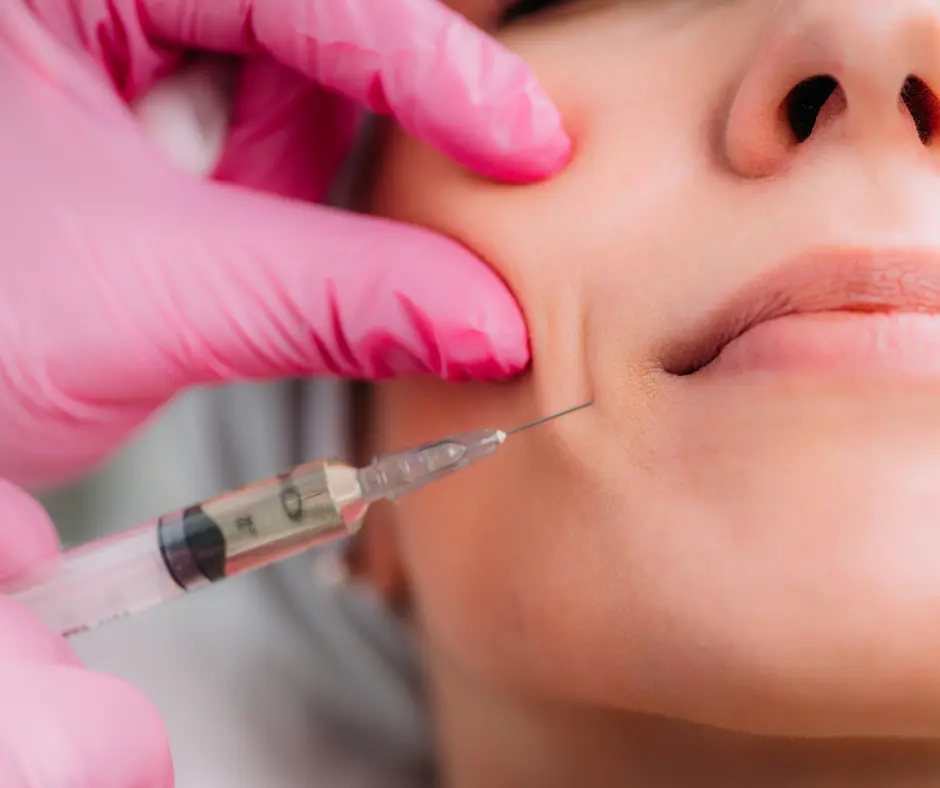 karisma rh collagen soft filler injection on Nasolabial or Marionette lines​