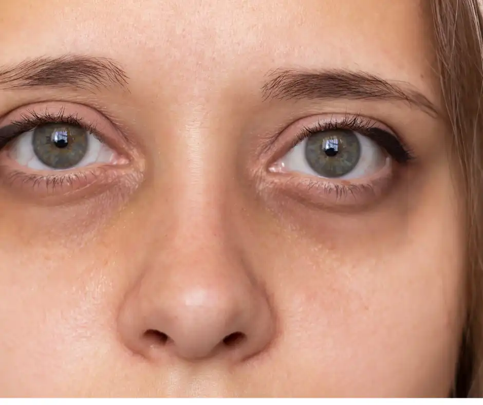 woman with dark circles around eye