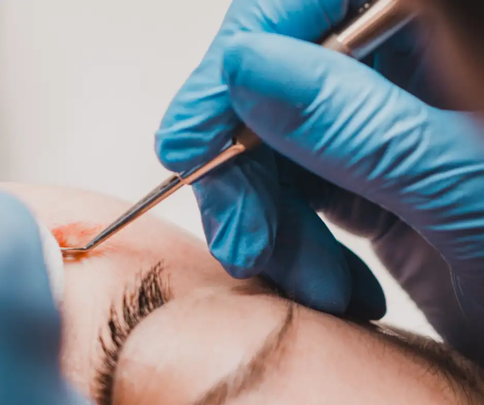 Milia removal near me