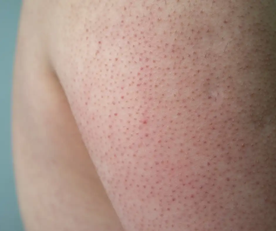 keratosis pilaris skin