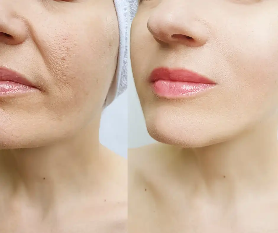 juvederm ultra 4 filler before and after