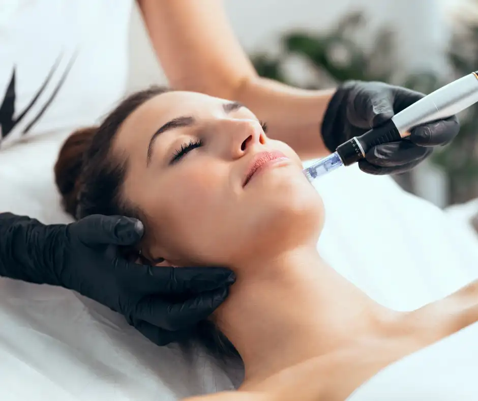 microneedling treatment for acne scars