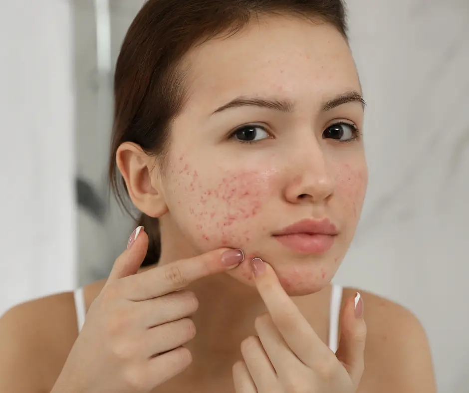 woman with acne prone skin with acne scars - treatment for acne scars