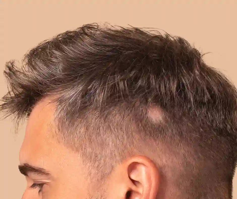 man have alopecia spot