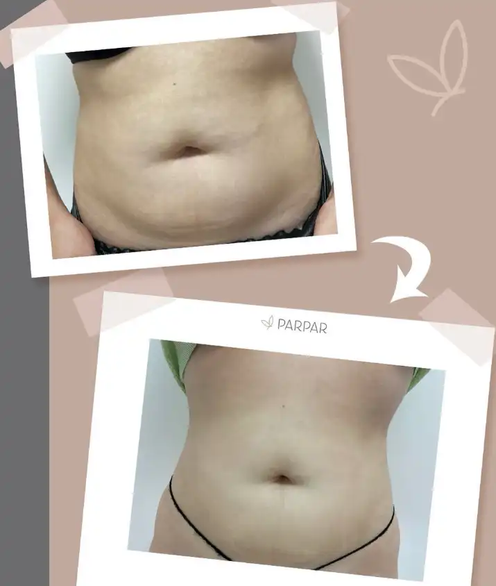 adominal muscle toning before and after