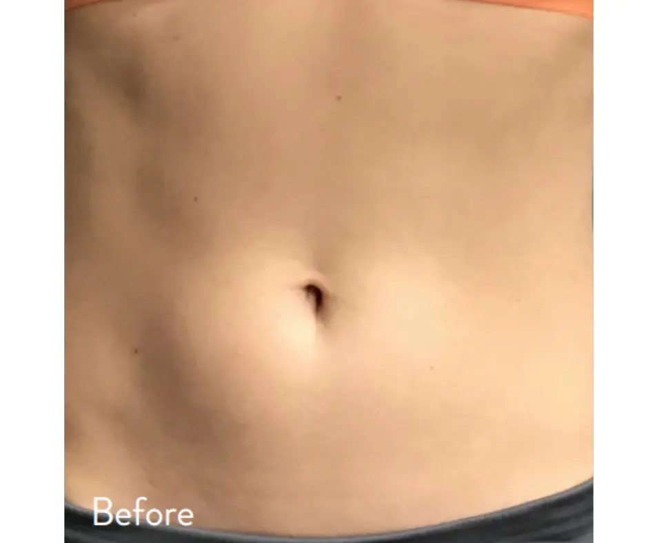 body sculpting results before and after