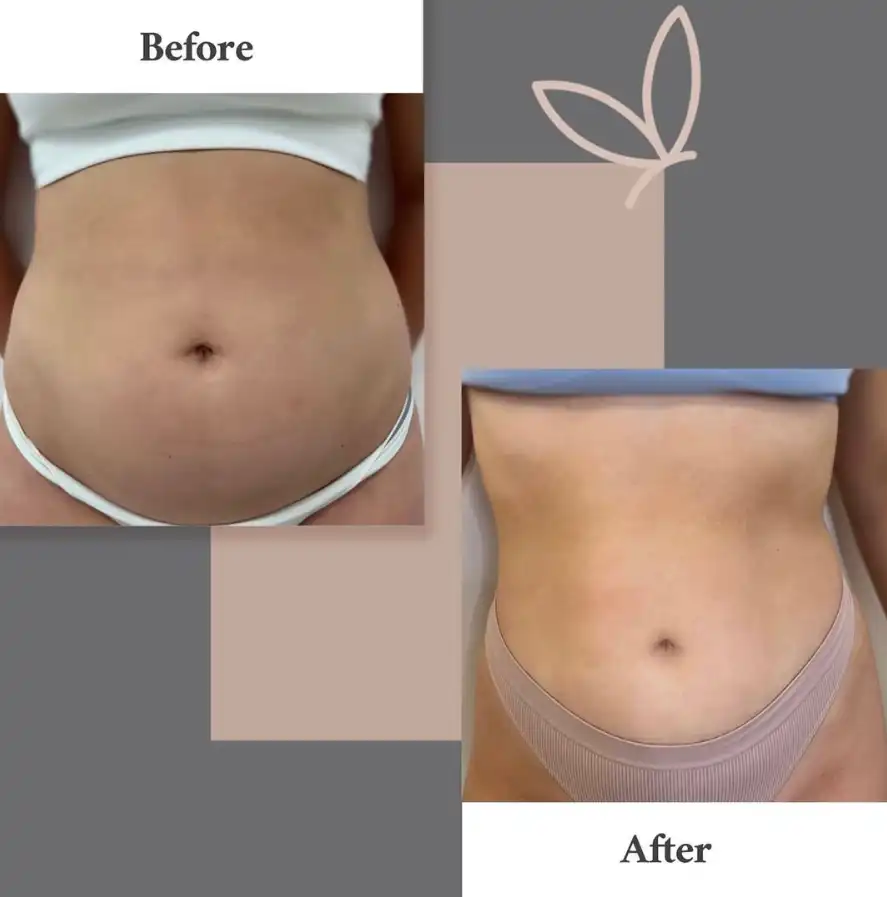 body contouring before and after