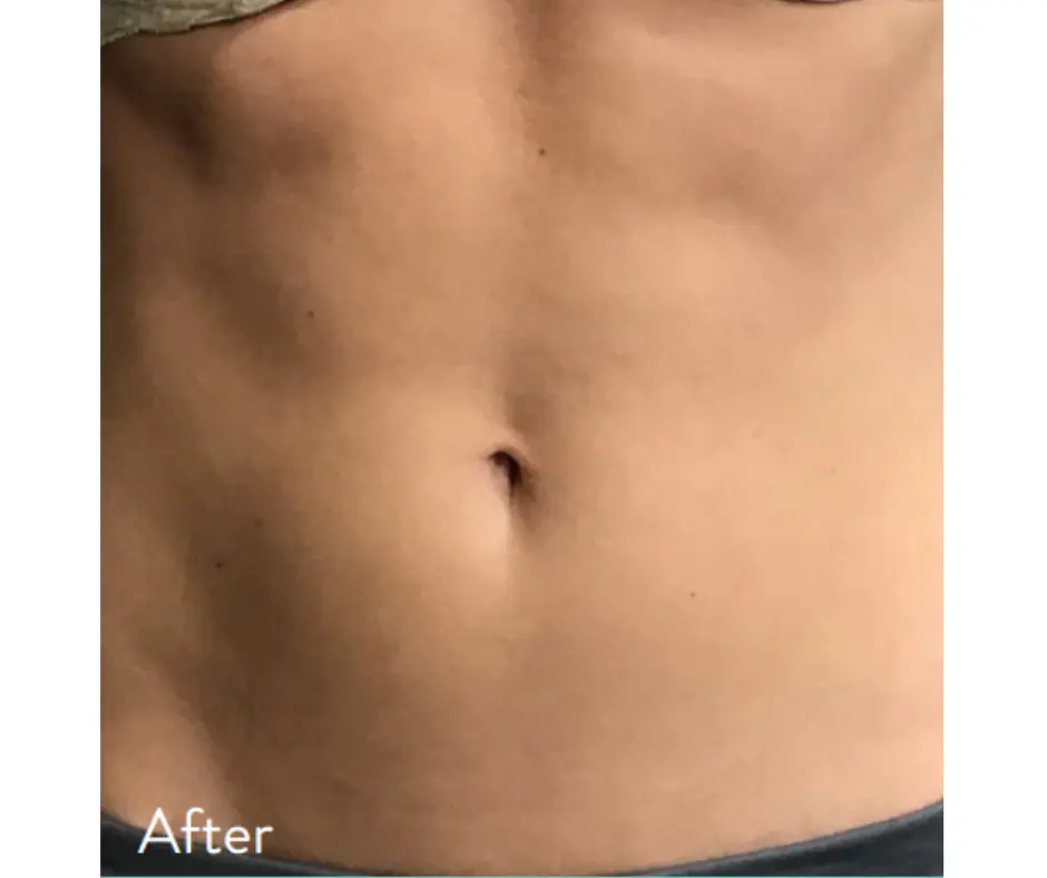 body sculpting results after treatment