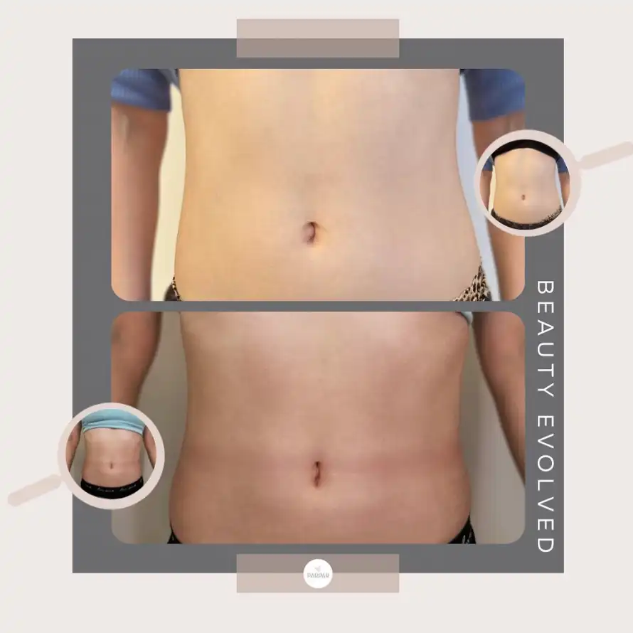 body controuring before and after - muscle toning