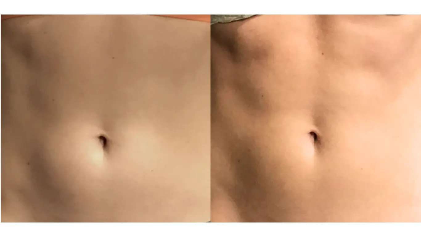 body sculpting before and after one session