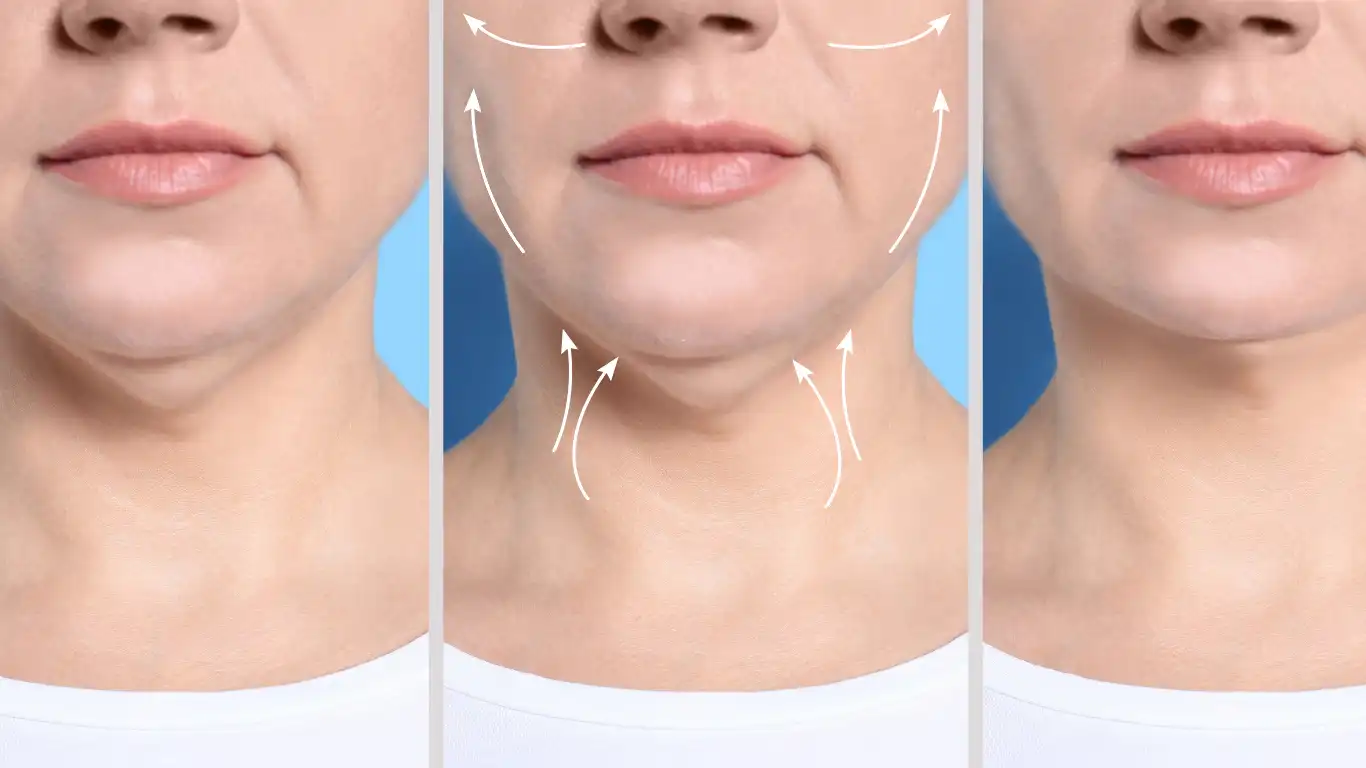 jowls vs double chin