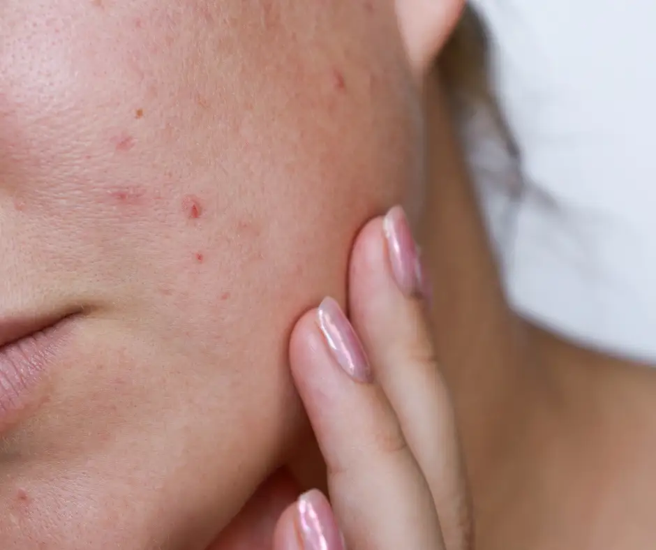 face with acne scars