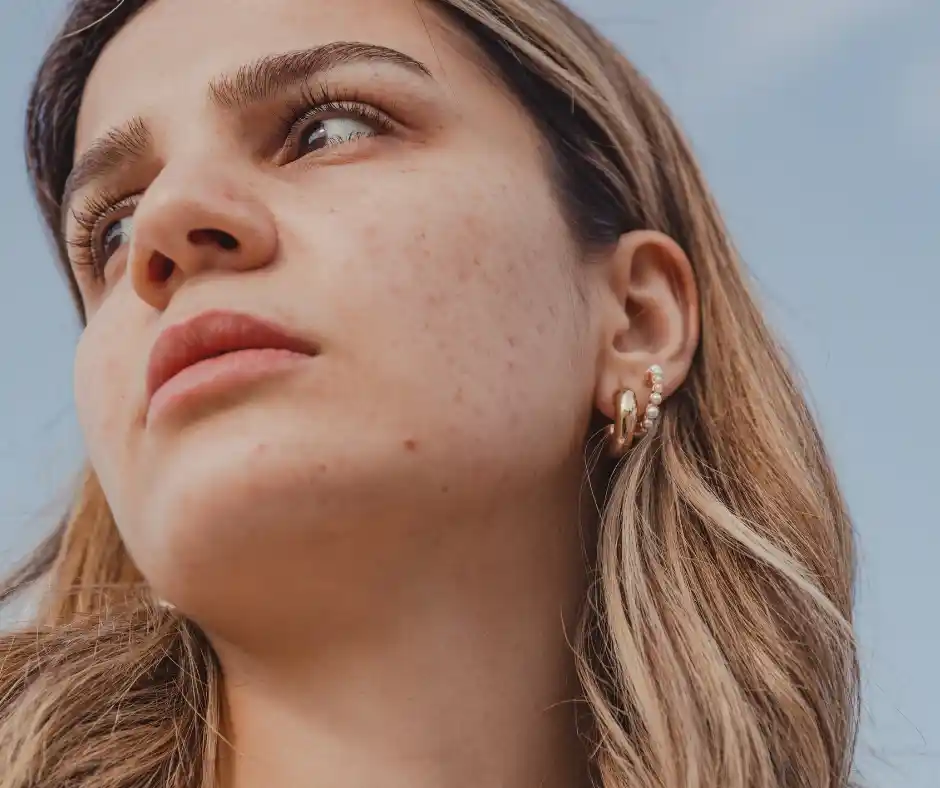 face having acne scars on cheeks and chins