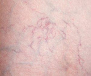 spider veins on skin