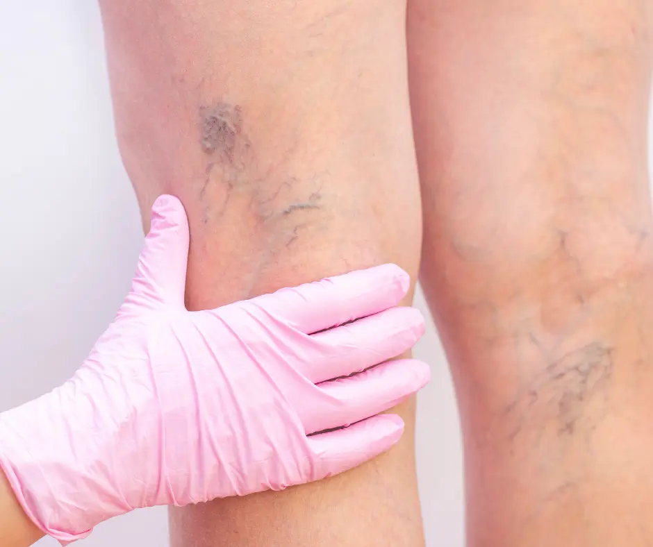 legs with spider veins