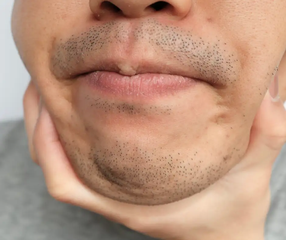 male stubble - facial laser hair removal for men's mustache