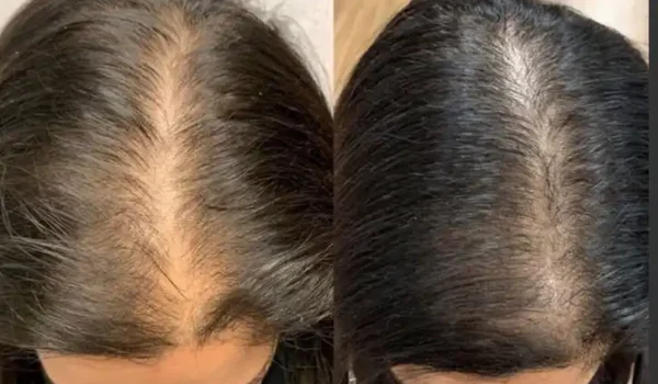 before and after treatment with keralase