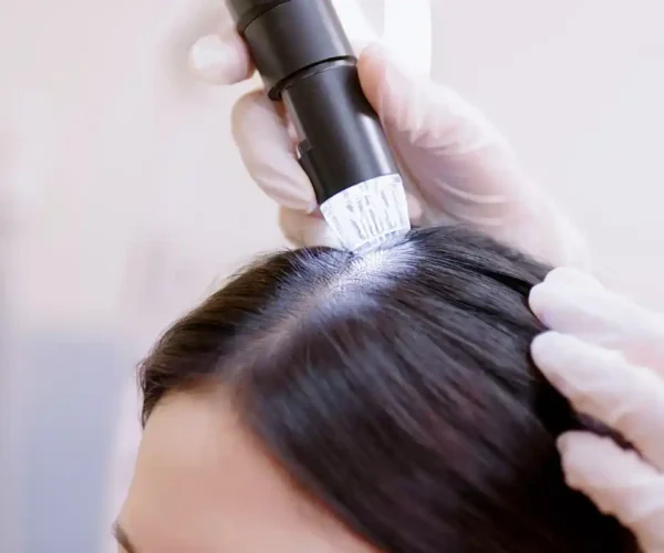 processs of scalp microneedling for non-surgical hair restoration
