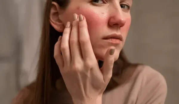 woman dealing with rosacea on her face